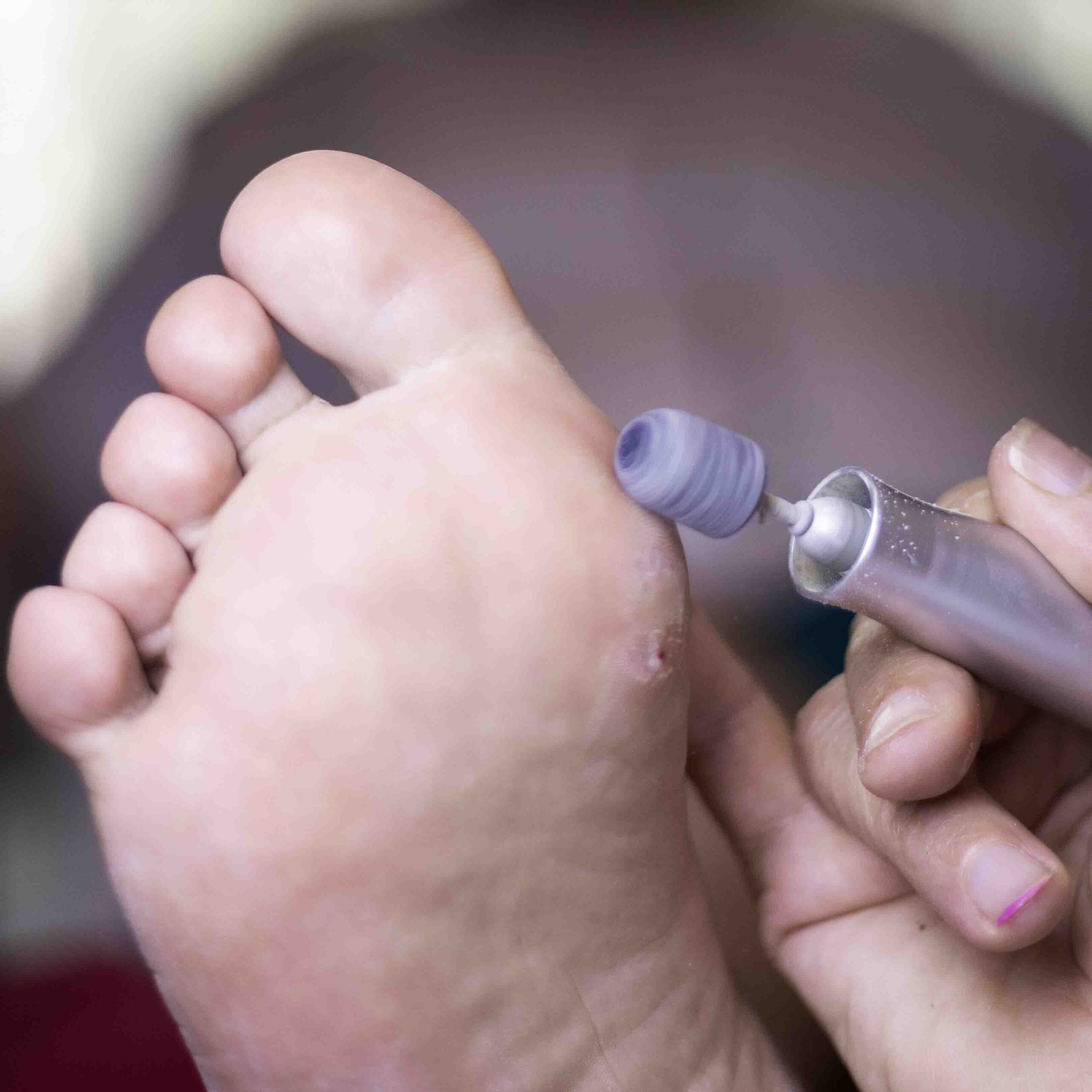 Broušení nohou, diabetická noha, pedikúra